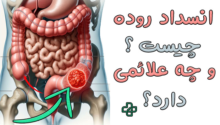 انسداد روده