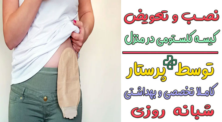 تعویض کیسه کلستومی در منزل