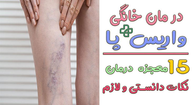 درمان خانگی واریس پا