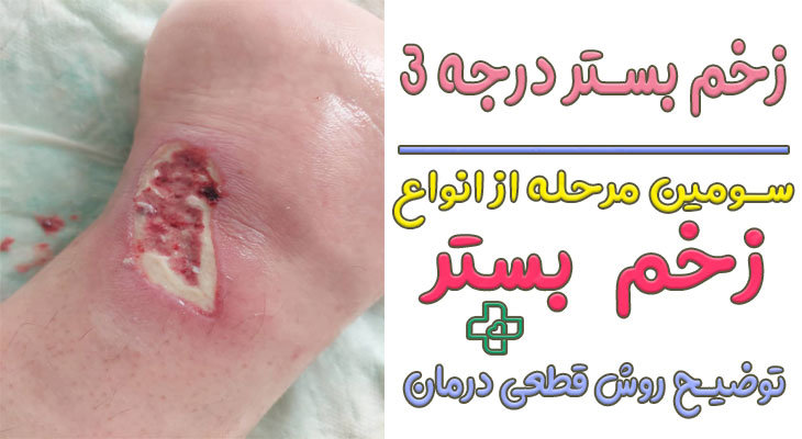 زخم بستر درجه ۳