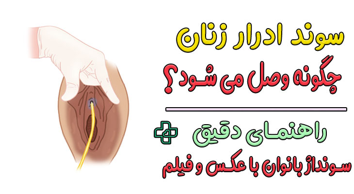 سوند ادرار زنان چگونه وصل میشود؟