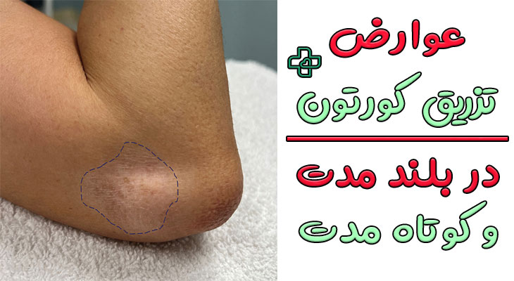 عوارض تزریق کورتون