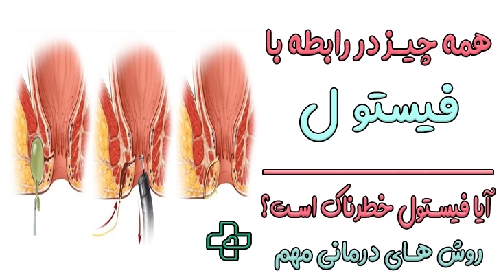 فیستول و نکات مهم آن