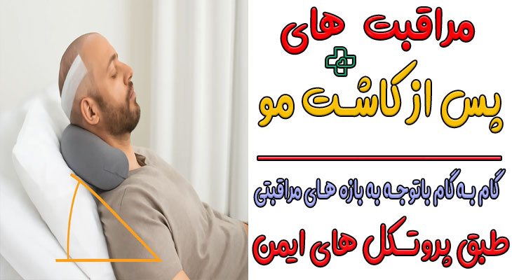 مراقبت های بعد از کاشت مو