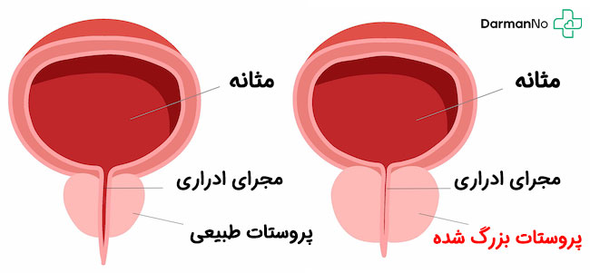پروستات در سالمندان