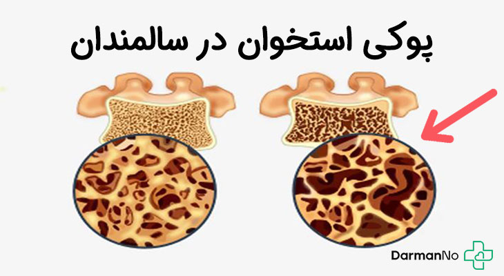 پوکی استخوان در سالمندان