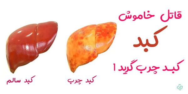 کبد چرب گرید ۱