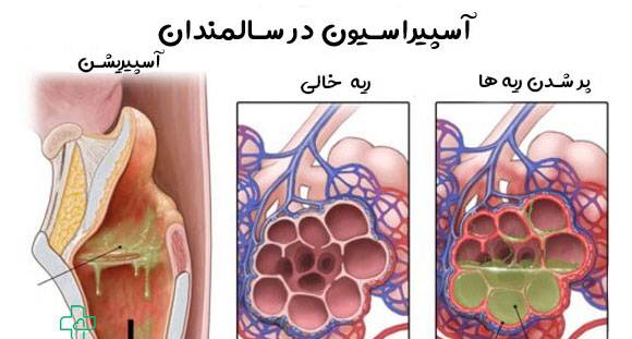 آسپیراسیون چیست؟