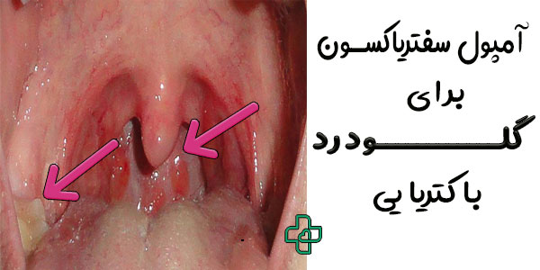 آمپول سفتریاکسون برای گلو درد