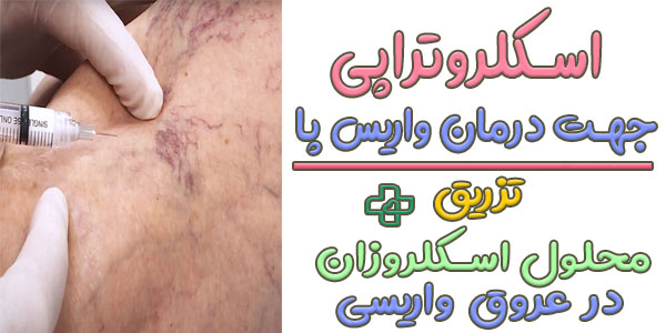اسکلروتراپی با تزریق