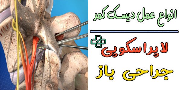 انواع روش عمل دیسک کمر چگونه است؟