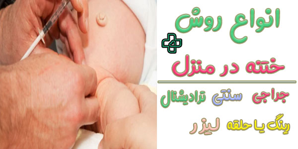 انواع روش های انجام ختنه در منزل چیست؟