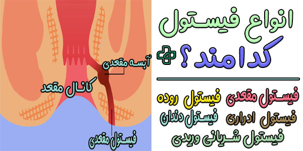 انواع فیستول ها به چند دسته تقسیم میشوند؟