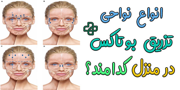 انواع نواحی تزریق بوتاکس در منزل کدامند؟ (براساس تفکیک نواحی تزریق)
