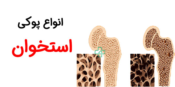 انواع پوکی استخوان در افراد مسن به چه صورت است؟