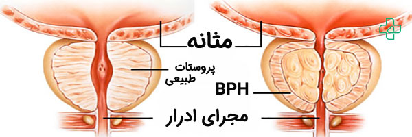 بزرگی پروستات در سالمندان به چه معناست؟