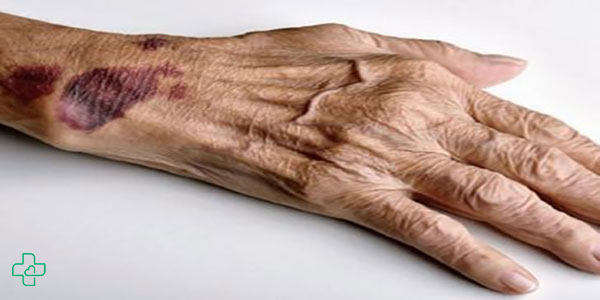 بیماری های سیستم ایمنی و نکات مهم آن در سالمندان
