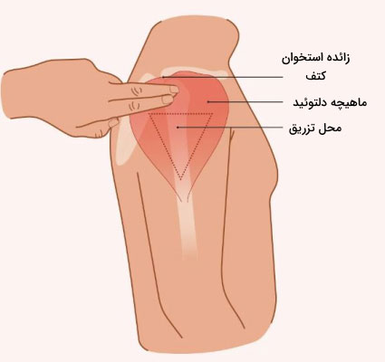 تزریق دلتوئید