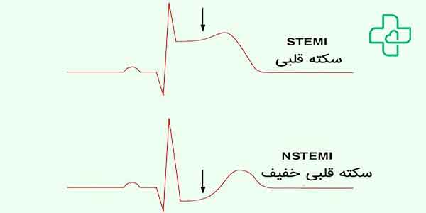 تغییرات مهم نوار قلب در سکته قلبی به چه صورت است؟