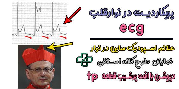 پریکاردیت در نوار قلب