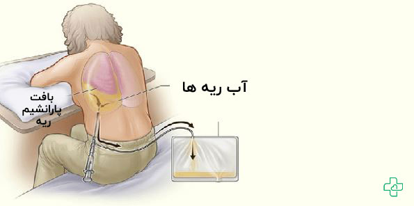 درمان آب آوردن ریه در سالمندان به چه صورتی است؟