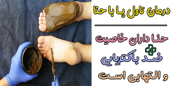 درمان تاول پا با حنا