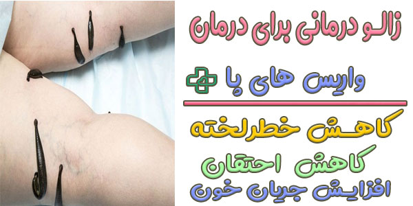 درمان خانگی واریس پا با زالودرمانی