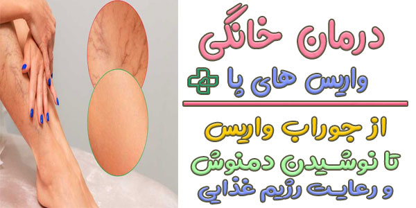 درمان خانگی واریس پا با 15 روش بی نظیر علمی