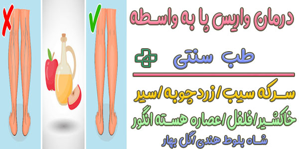 درمان خانگی واریس پا در طب سنتی (نگاه دکتر خیراندیش)