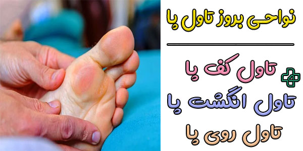 تاول پا معمولا در کدام نواحی پا بروز می کند؟