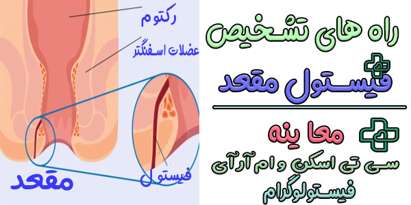 راه های تشخیص فیستول مقعدی چیست؟