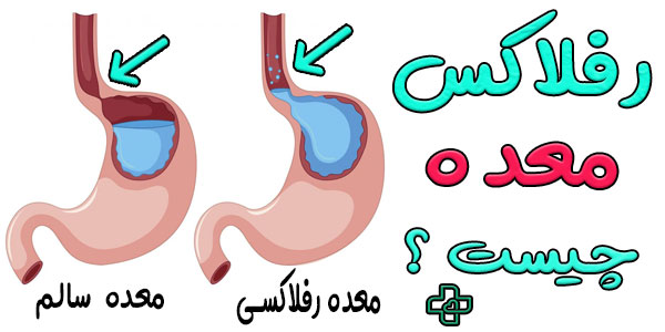 رفلاکس معده چیست؟