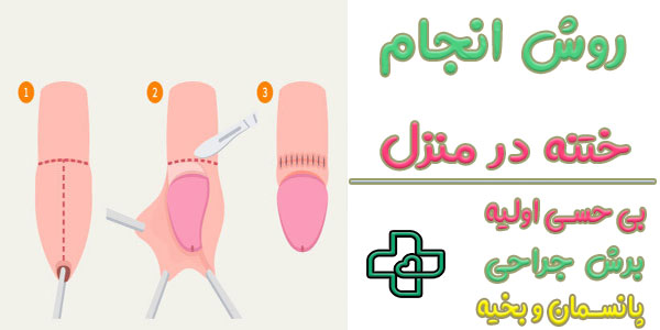 روش انجام ختنه در خانه چگونه است؟