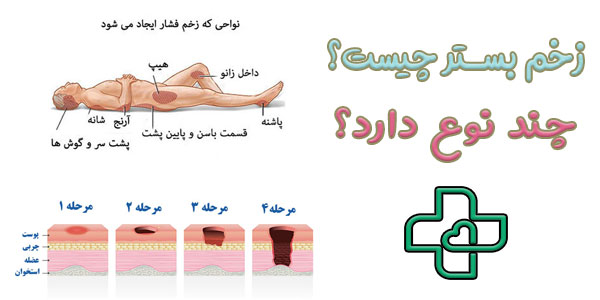زخم بستر چیست و چند نوع دارد؟