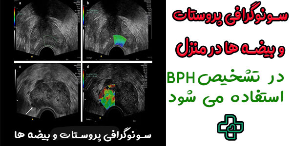 سونوگرافی پروستات در منزل