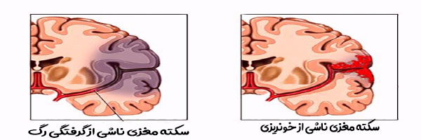 سکته مغزی چیست؟