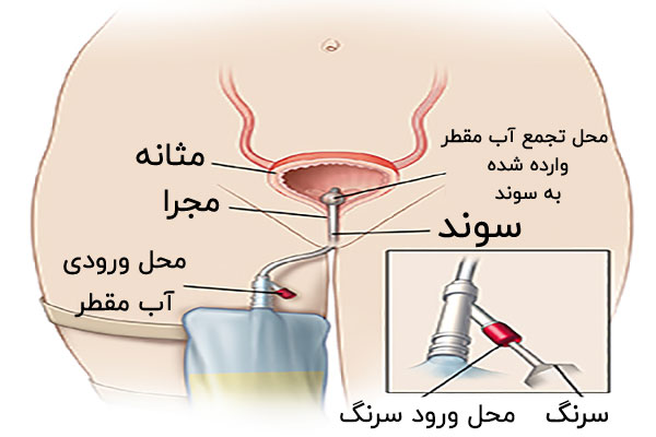 طریقه نصب سوند در زنان