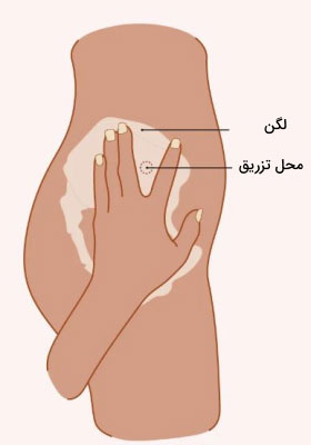 عضله گلوتئال
