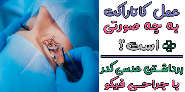 عمل آب مروارید چگونه است؟ (روش های رایج آن)