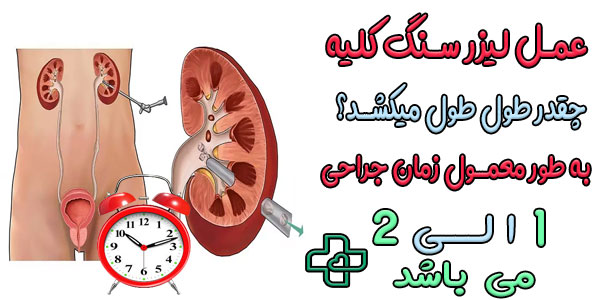 عمل لیزر سنگ کلیه چقدر طول میکشد؟