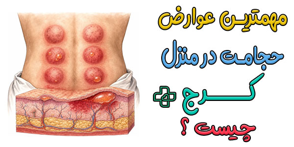 عوارض انجام حجامت در منزل کرج چیست؟