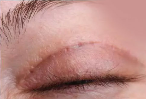 عکس بخیه زیر پوستی