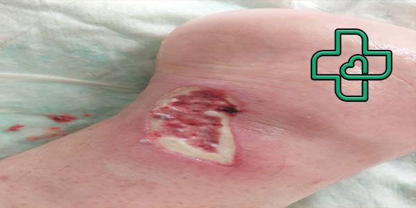 عکس زخم بستر درجه 3 نمونه تخصصی