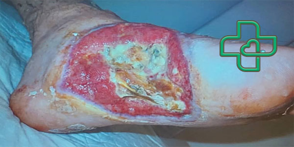 عکس زخم بستر درجه 3