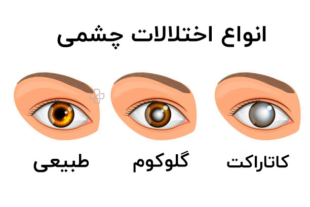 فرق آب مروارید چشمی با آب سیاه چشم چیست؟