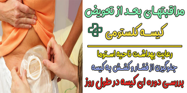 مهم ترین مراقبتهای بعد از تعویض کیسه کلستومی در منزل
