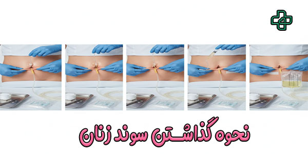 سوند ادرار زنان چگونه وصل میشود؟ (آموزش 10 گام علمی و عملی)