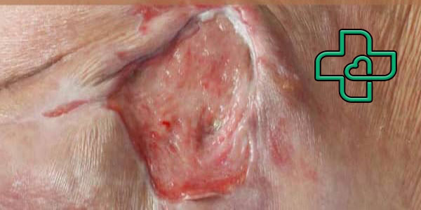 نمونه عکس زخم بستر درجه 3