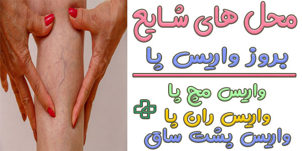 واریس پا در مناطقی از پا بیشتر دیده میشود؟