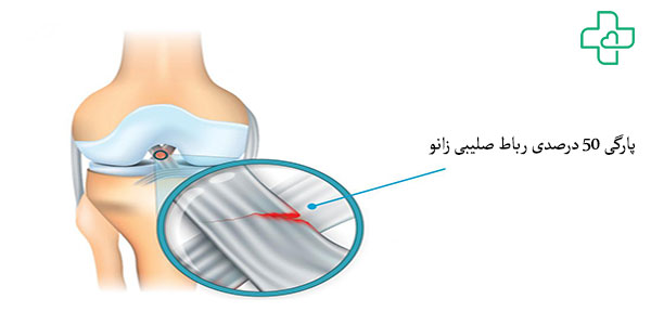 پارگی نیمی از رباط صلیبی